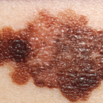 melanoma