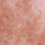 melasma