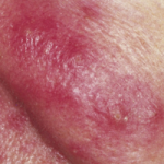 rosacea