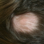 alopecia areata_0234