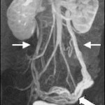 pelvic congestion syndrome