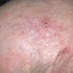 actinic keratosis