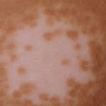 vitiligo-2